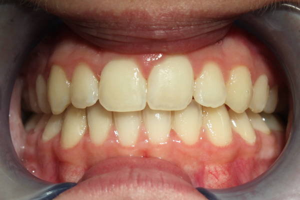 Orthodontie behandeling