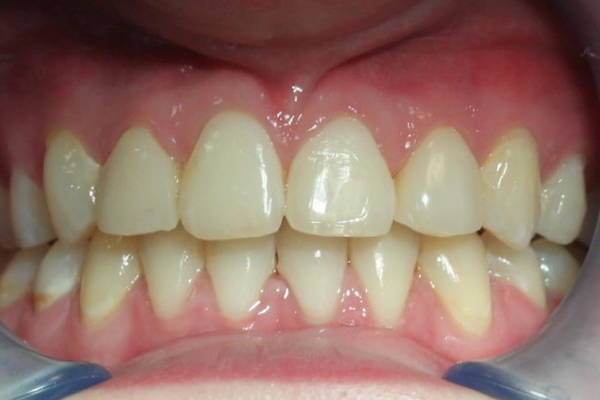 Orthodontie behandeling