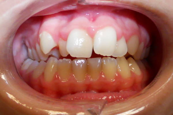 Orthodontie behandeling