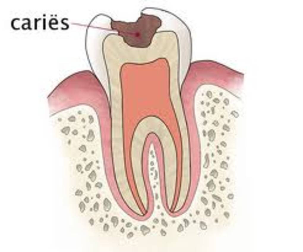 Vullingen / cariës